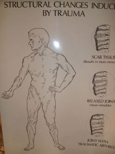 Structual Changes Induced by Trauma Laminated Chart