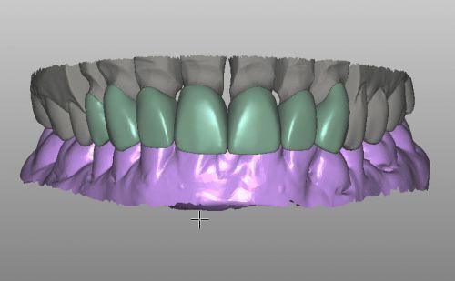 DENTAL LAB CAD DESIGN WORK , FREE DESIGN YOUR TEST CASE.specialize in CAD/CAM.