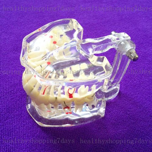 ON SALE!1 Pc Dental Study Tooth Transparent Adult Pathological Teeth Model