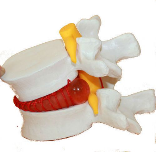 Chiropractor Subluxation Degeneration Pinched Nerve Model