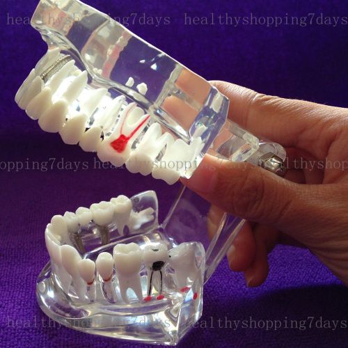 For study /learn! Dental Implant Teeth restoration demonstration teaching model