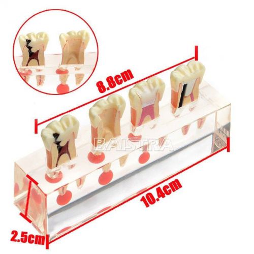 Dental pulp Pathology Treatment Study Teaching Teeth Model ZYR-4018