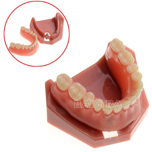 New dental teeth study teach model implant repair model #6007 for sale