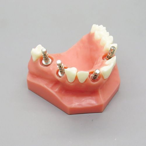 1 Pc Dental Teeth Model Upper Jaw Implant Model Red 2012 01