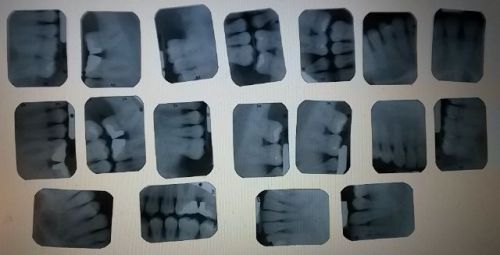 Teeth X-Rays