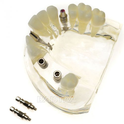 Dental Dentist Tooth Planting Study Model