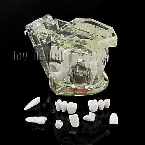 New dental implant study analysis demonstration teeth model with restoration for sale