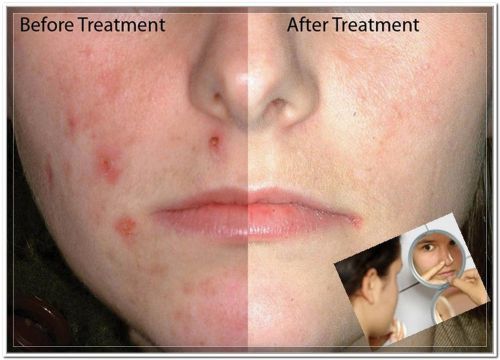 Acne Gel 15g Treatment of Acne Vulgaris, Pimple Inflammatory