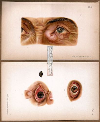 EXTERNAL OPHTHALMIC EYE DISEASES - Lot of 6  Prints c1900