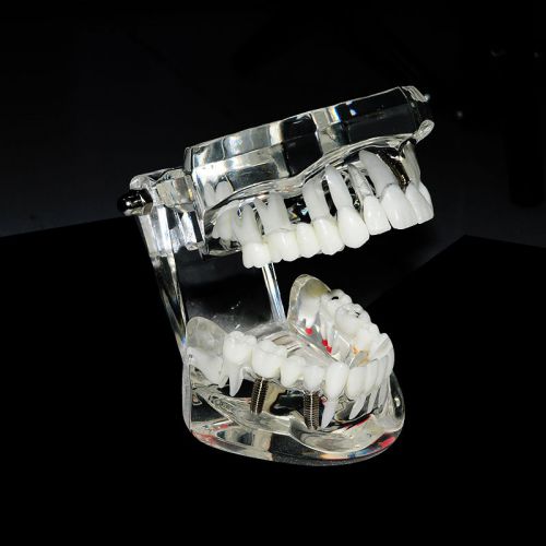 Free shipping Dental Implant Disease Teeth Model with Restoration &amp; Bridge Tooth