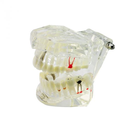 1 Pc Dental Implant Disease Teeth Model with Restoration &amp; Bridge Tooth