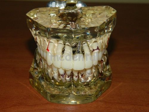 TYPODONT TRANSPARENT PATHOLOGIES IMPLANT MODEL TEETH DENTOFORM