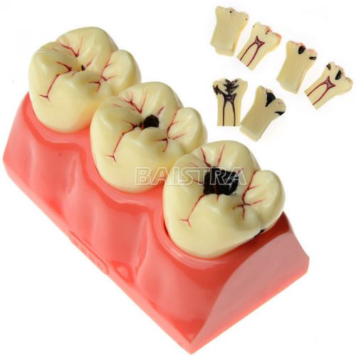 Dental Patient Education Model Caries Treatment Study Model ZYR-4013