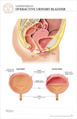 11x17 Post-It Disease Chart: OVERACTIVE BLADDER-FEMALE