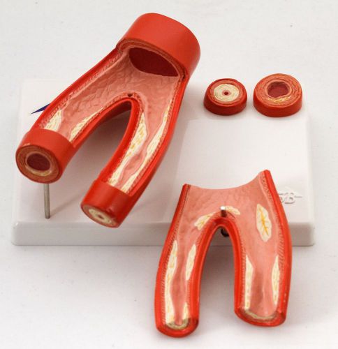 Anatomical Human Artery with Arteriosclerosis - Cross Section of Artery Model