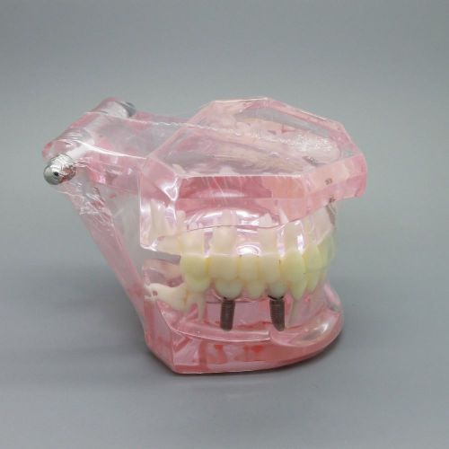 Dental Implant Study Education Analysis Demonstration Model with Restoration