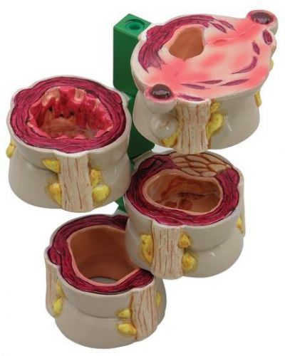 NEW Anatomical 4-Piece Colon with Pathologies Model