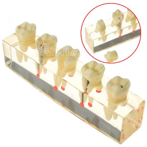 Dental Teeth Study Teaching Model Endodontic Treatment Demonstration #4012