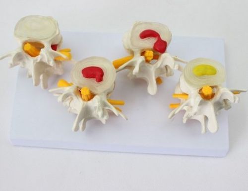 NEW 4-Part 24*14*14cm Lumbar Vertebra Diseased Contrast Medical Model 47