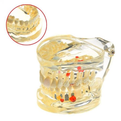 New Dental Teeth Adult Pathologies Model for Demonstration Teach Study #4019-II