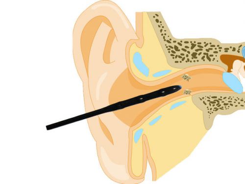 New concept earwax removal 20 sticky sticks get earwax out of ear free shipping for sale