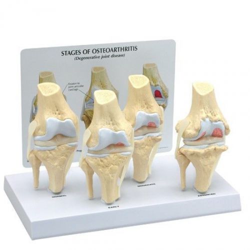 NEW GPI Anatomical 4-Stage Human Osteoarthritis Knee Model 1100