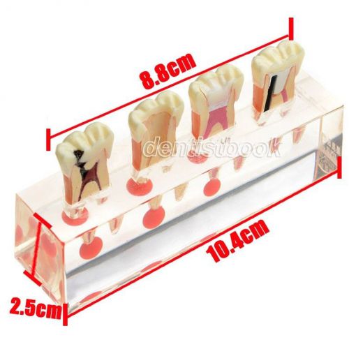 New dental pulp pathology treatment study teaching teeth model #4018 for sale