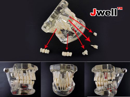 Dental Implant Disease Teeth Model with Restoration w/ Bridge Tooth