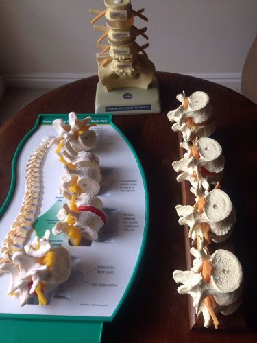 4 Stages Of Lumbar Degeneration Anatomical Model Vertebrae Set