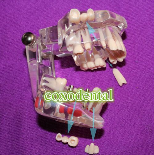 Supply Dental Teeth Study Model Classic Implant Typodont Model Restoration #1401