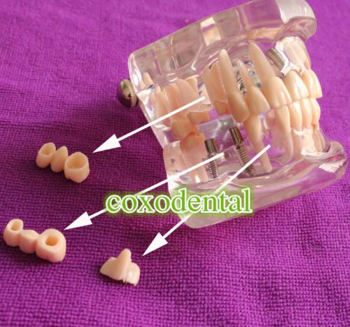 Dental Implant Study Analysis Demonstration Teeth Model