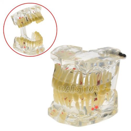 HOT SALE Dental Adult Pathologies Model Teeh Tooth Teach Study Model 4001-I