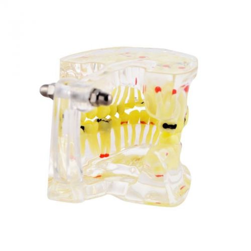 Dental Study Tooth Transparent Adult Pathological Teeth Model