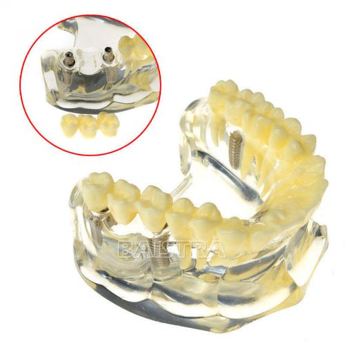 New 1 pc dental implant demonstration model teeth study #6008 for sale
