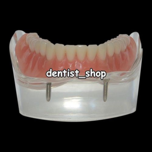 Dental Overdenture Tooth Model Inferior with 2 Implants