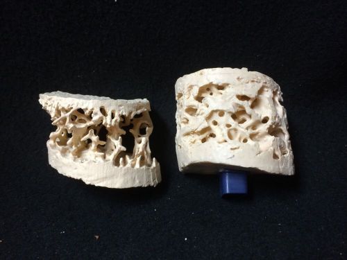 Spongy Bone Structure Anatomical Teaching Model Cancellous Bone Pathology 2 Pc