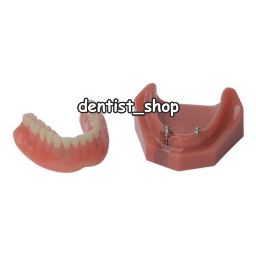 Dental Overdenture Teeth Model Inferior with 2 Implants 6007#