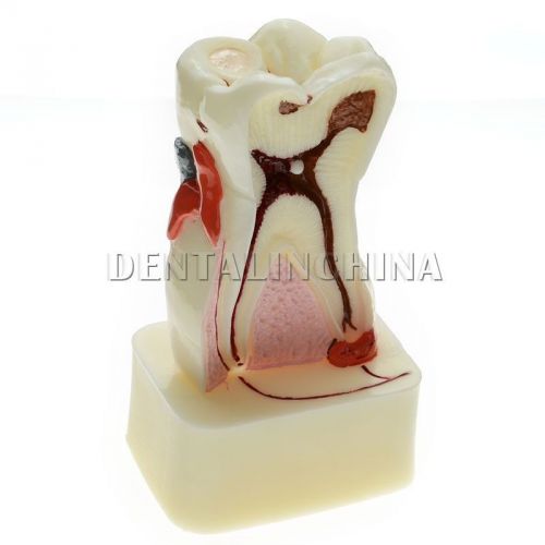 1pc Dental Study Teaching Model Teeth Comprehensive Disease Model