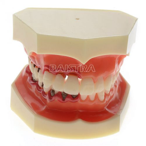 Dental study teeth tooth model transparent adult pathological model zyr-4003 for sale