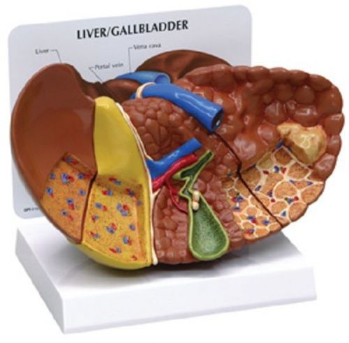 NEW Anatomical Human Liver Diseased Cancer Model