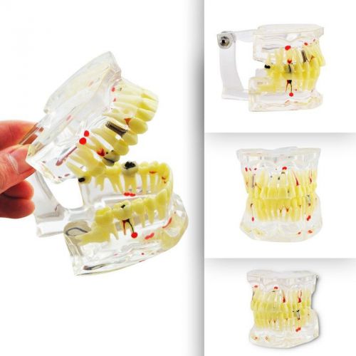 New Dental Study Tooth Transparent Pathological Teeth Model