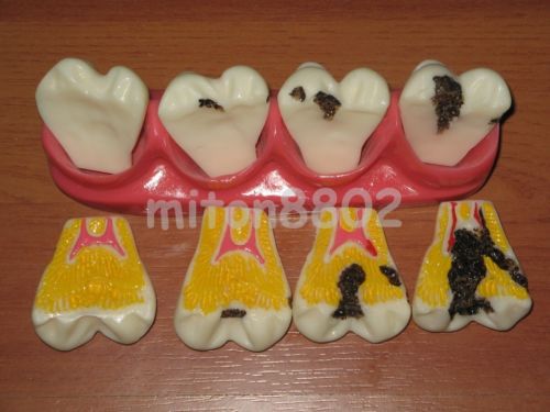 NEW TYPODONT MODEL EVOLUTION OF TEETH CARIES CAVITY STUDY