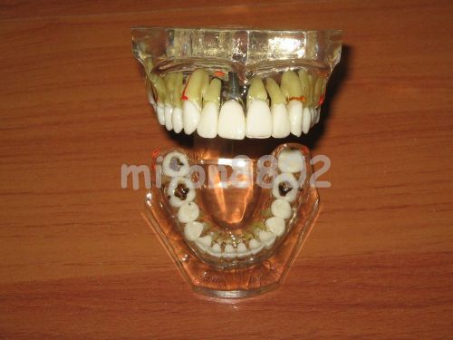 Typodont transparent pathologies implant model teeth study for sale