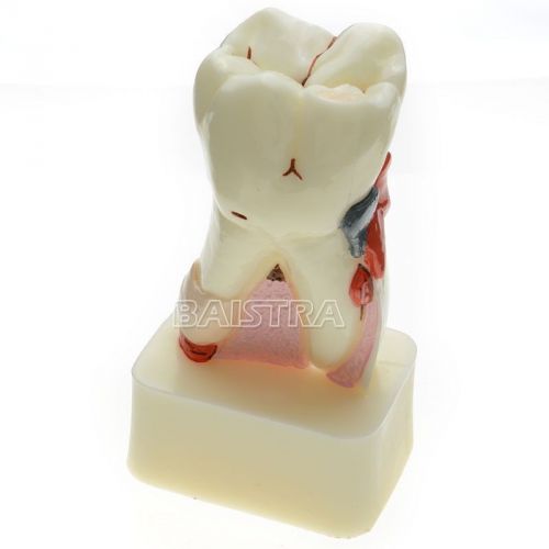 Dental Study Teaching Model Teeth Comprehensive Disease Model #4015