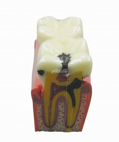 New Dental Study Teeth Model Orthodont and Caries Comparison Teeth Model G176