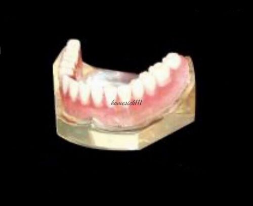 XINGXING Overdenture Inferior With 4 Implants Restoration Tooth Model 6001 HO