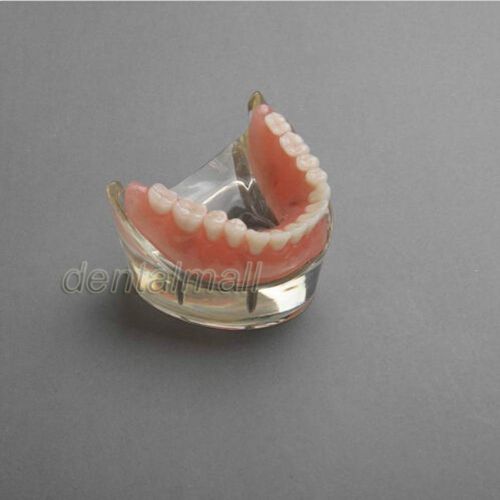 New Dental Model Overdenture Inferior with 4 Implants Demo #6002-02