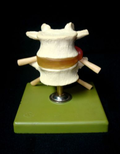 SOMSO QS67 Hernia of Dorsolateral Intervertebral Disc Anatomical Model (QS 67)